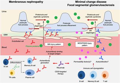 Pathophysiology Of Nephrotic Syndrome